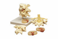 LUMBAR VERTEBRAE MODEL W/HERNIATED DISC